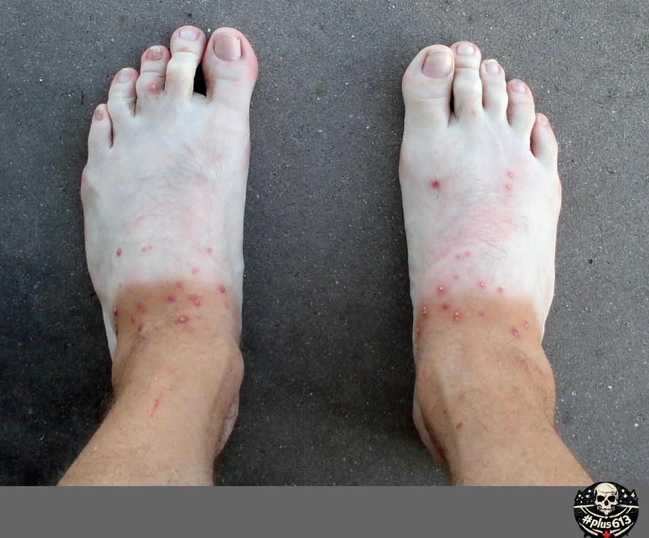 Suntan and fire ant bites (old pic)
