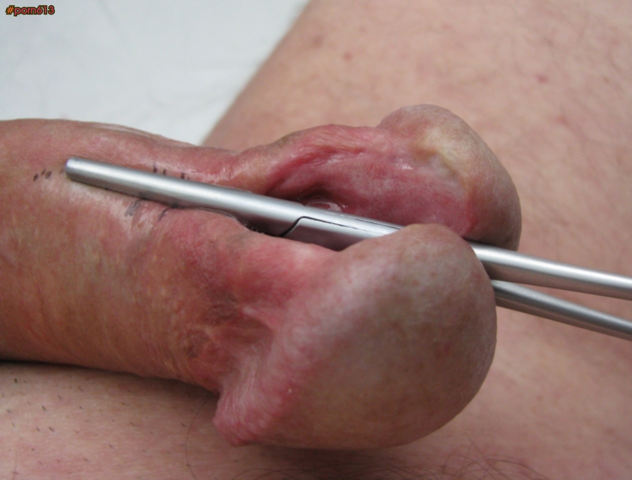 Porn613 Adult Image Gallery Penile Mutilation