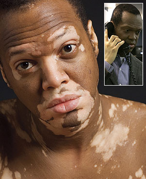 Lee Thomas has vitiligo, maybe Jacko was telling the truth...