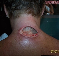 spider bite