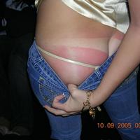 TAN LINE BURN