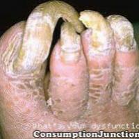 ho's toes
