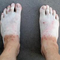 Suntan and fire ant bites (old pic)