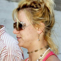 Britney's Pock Marks