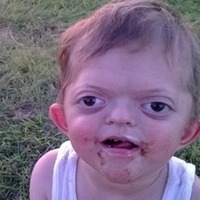Pfeiffer syndrome